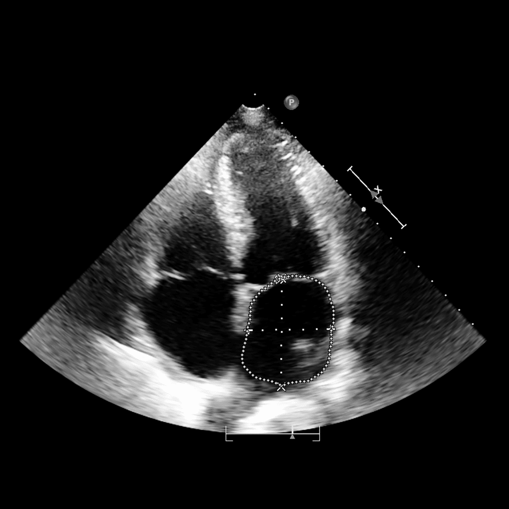 heat ultrasound