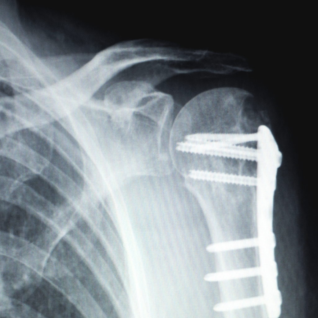 shoulder implant x-ray