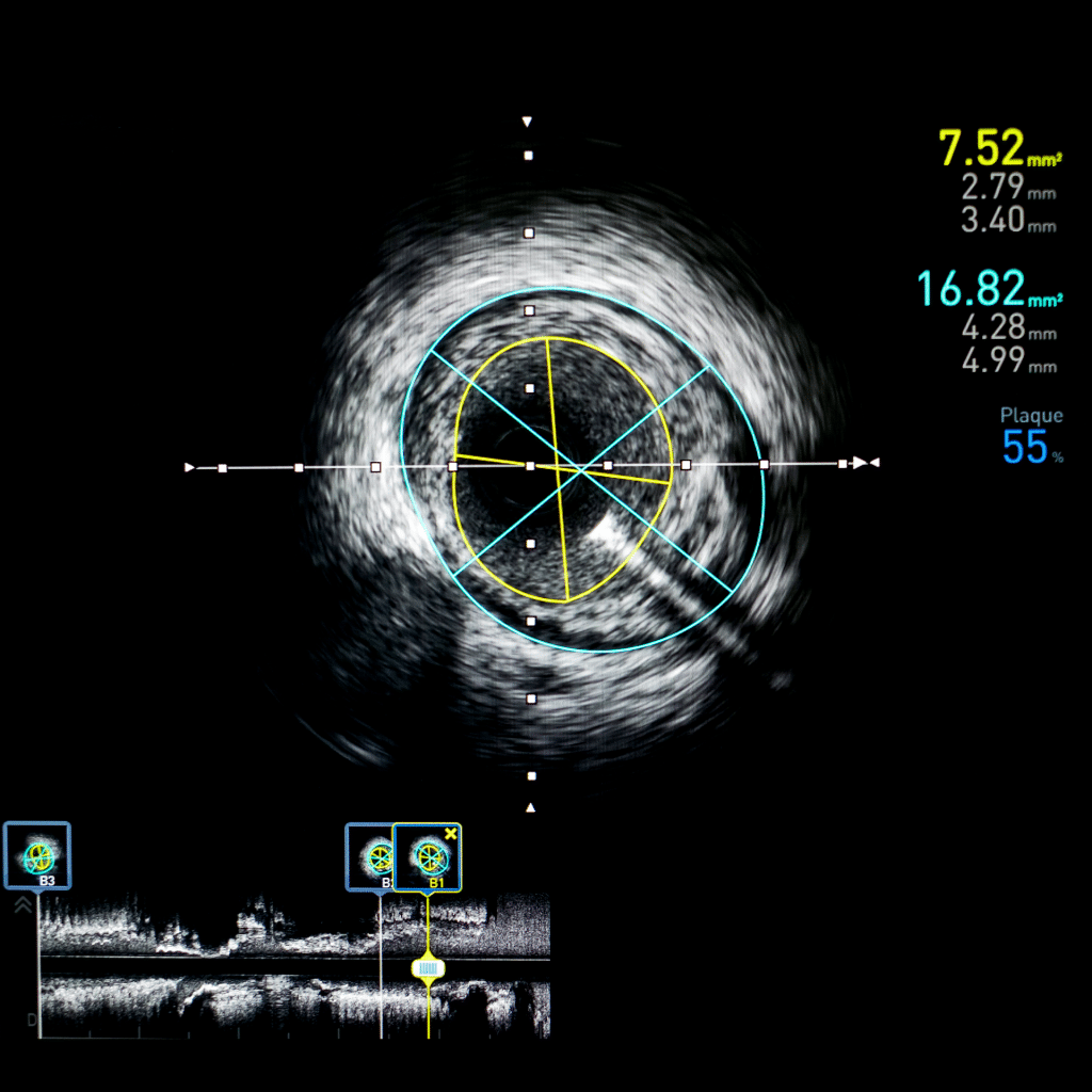 vascular compression imaging 3