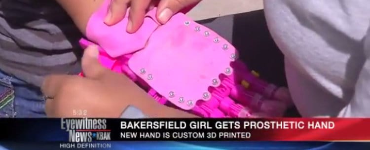 bakersfield girl gets prosthetic hand